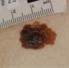 picture of melanoma